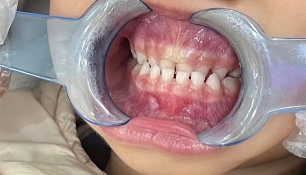 乳牙“地包天”不及时矫治会影响恒牙吗？